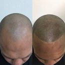 Full Micropigmentation - Hair Replacement