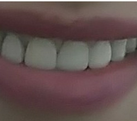 Southern Dental Associates - Houston, TX. first set of crowns. Had to many gaps, kept getting food caught between  my teeth. Never had this issue before.