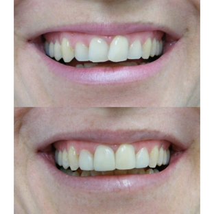 Bytes Dental Lismore - Goonellabah, NSW. Composite Resin Veneers