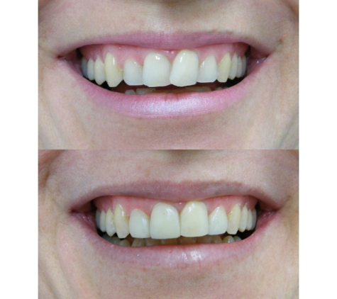 Bytes Dental - Ballina - Ballina, NSW. Composite Resin Veneers