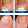 Laser Nail Therapy Clinic-Toenail Fungus Treatment Tustin CA gallery