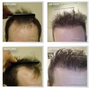 Natural Transplants, Hair Restoration Clinic - Medical Clinics
