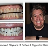 Rock Star Teeth Whitening gallery