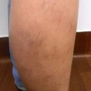 Shapiro Vein Center - Physicians & Surgeons, Pathology