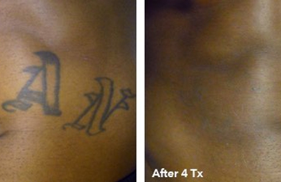 New Technology makes laser tattoo removal faster more effective and less  painful  YouTube