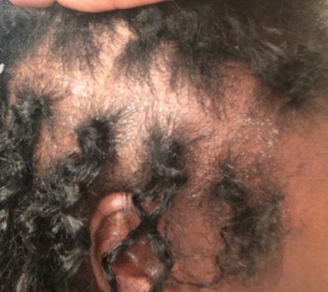 Francin's African Hair Braiding - Herndon, VA. All the bumps, thinned hair, aggravated scalp. Stay away from this place!!!