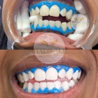 Halo Ali Teeth Whitening