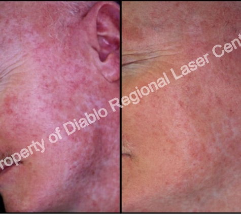 Diablo Regional Laser Center - Walnut Creek, CA