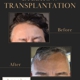 Arocha Hair Restoration
