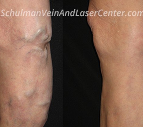 Martin Schulman, MD - Schulman Vein and Laser Center - Commack, NY