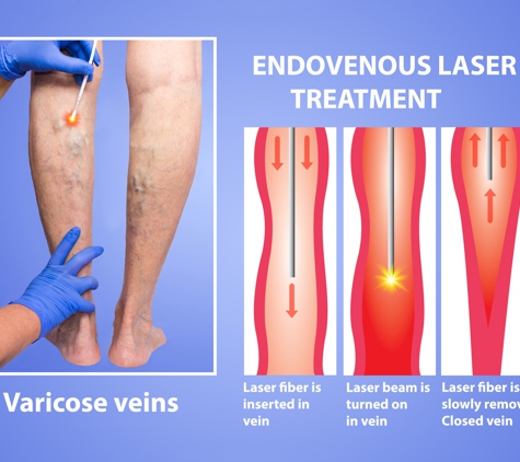 Charming Skin & Vein Clinics - Orland Park, IL. Endovenous Laser Treatment of Varicose veins