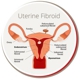 USA Fibroid Centers