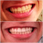 Maui Whitening North Tampa