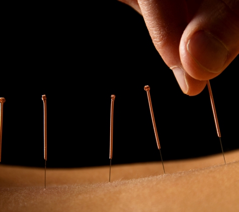 6S PHYSIO Mingara - Tumbi Umbi, NSW. Acupuncture delivered by experienced TCM practitioners; Dry needling performed by Physios