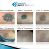 San Diego Laser Removal gallery