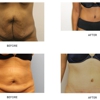 Liposuction and Cosmetic Surgery Institute gallery