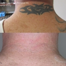 Integrity Ink - Tattoo Removal