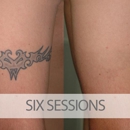 Eraditatt Tattoo Removal - Tattoo Removal