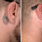 ReversaTatt Tattoo Removal