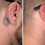 ReversaTatt Tattoo Removal