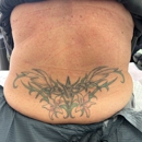 Tatt2Away® Draper - Tattoo Removal