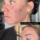 ABK SKIN | Facials & Hydrafacials in Charlotte, NC | Med Spa & Esthetician - Medical Spas