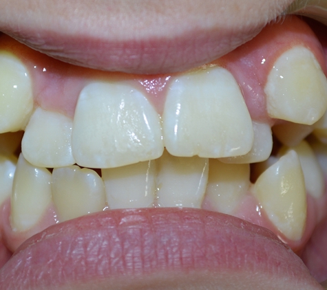Wholistic Dentistry - Queanbeyan, NSW. Before