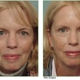 Allcroft Facial Plastic Surgery