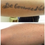 MEDermis Laser Tattoo Removal - San Antonio, TX