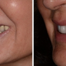 AH Smiles: Brent A. Engelberg, DDS - Implant Dentistry