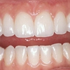 TLC For Gums - Gordon Wilson, DDS gallery