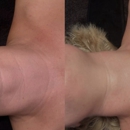 The Skin Angel Aesthetics - Hair Removal