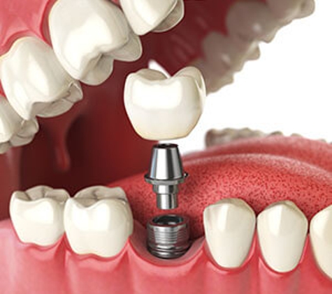 Trinity Beach Dental Practice - Trinity Beach, QLD. Implant Restorations In Trinity Beach