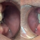 Dental Care of Mesa - Implant Dentistry