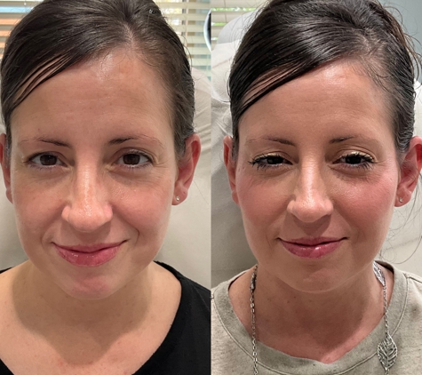 4ever Young STL - St.Louis, MO. Before and After Cheeks Fillers