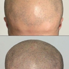 Semper Hair Scalp Micropigmentation