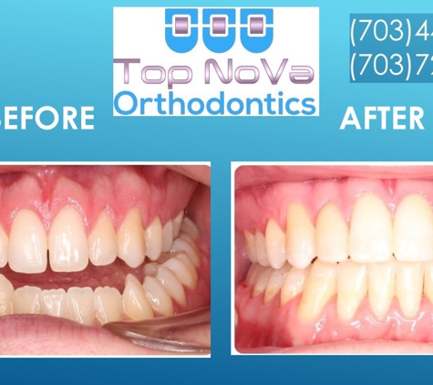 Top Nova Orthodontics - Sterling, VA