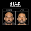 Tampa Hair Restoration Center - Hair Replacement