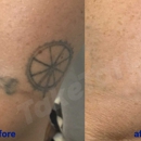 TakeTatt Tattoo Removal - Tattoo Removal