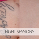 EradiTatt Tattoo Removal of Tampa
