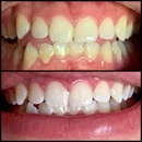 Carte Blanche Teeth Whitening - Teeth Whitening Products & Services