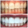 Organically White Teeth Whitening gallery