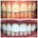 Organically White Teeth Whitening - Cosmetic Dentistry