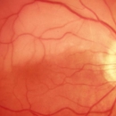 Retina Treatment Center - Physicians & Surgeons, Ophthalmology