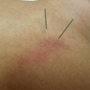 Laurel County Physiatry and Pain - Acupuncture