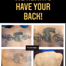 Removery Tattoo Removal & Fading - Tattoo Removal