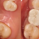 Summit Family Dental Care - Implant Dentistry