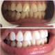 Diamond Smiles Teeth Whitening