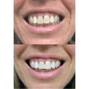 Bytes Dental - Ballina - Ballina, NSW. Tooth whitenin
