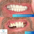 Tampa Dental Implants - Implant Dentistry